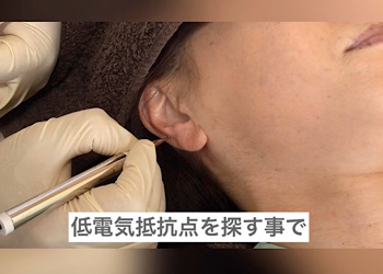 耳介療法